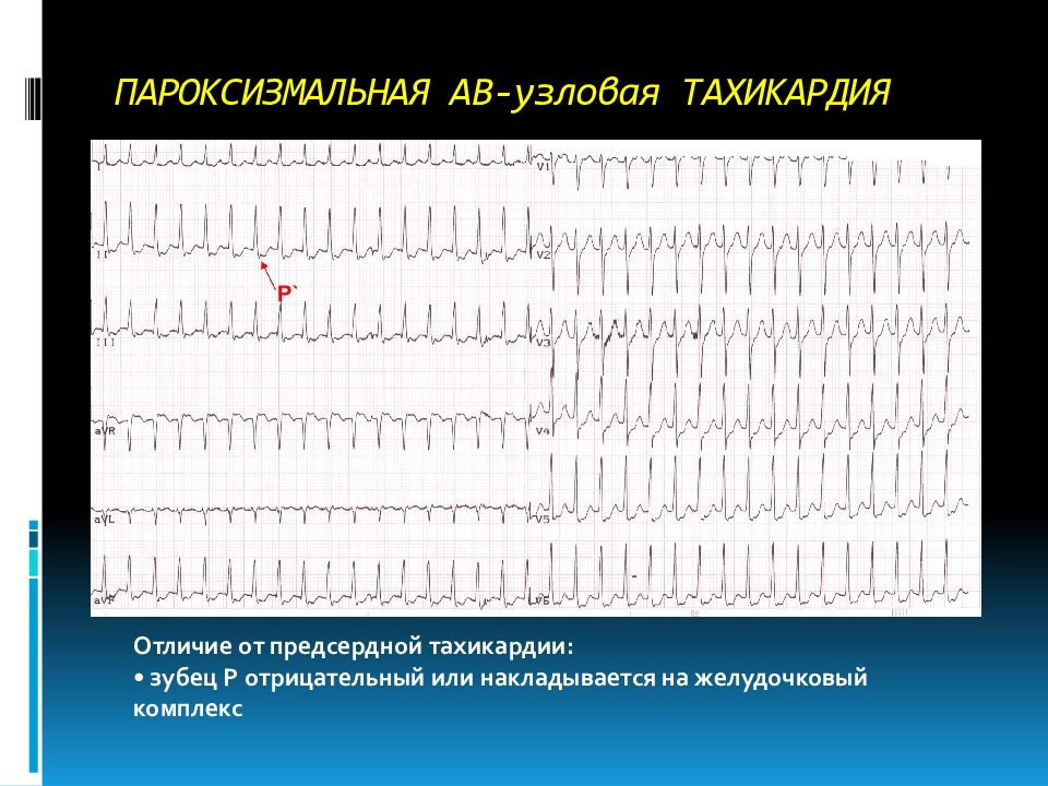 Пароксизмальная тахикардия презентация