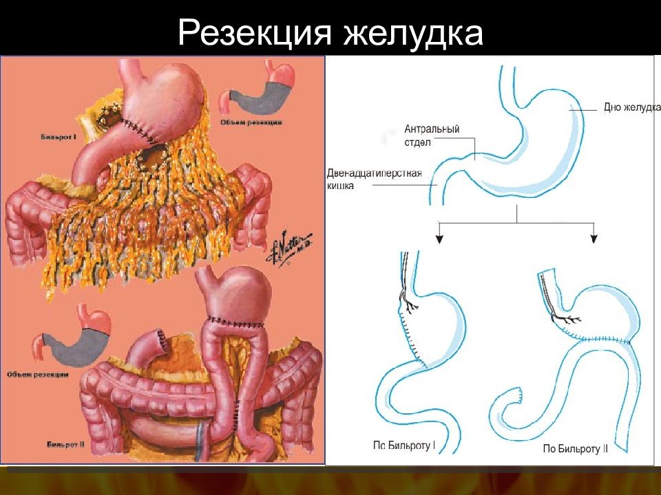 Резекция желудка по бальфуру схема