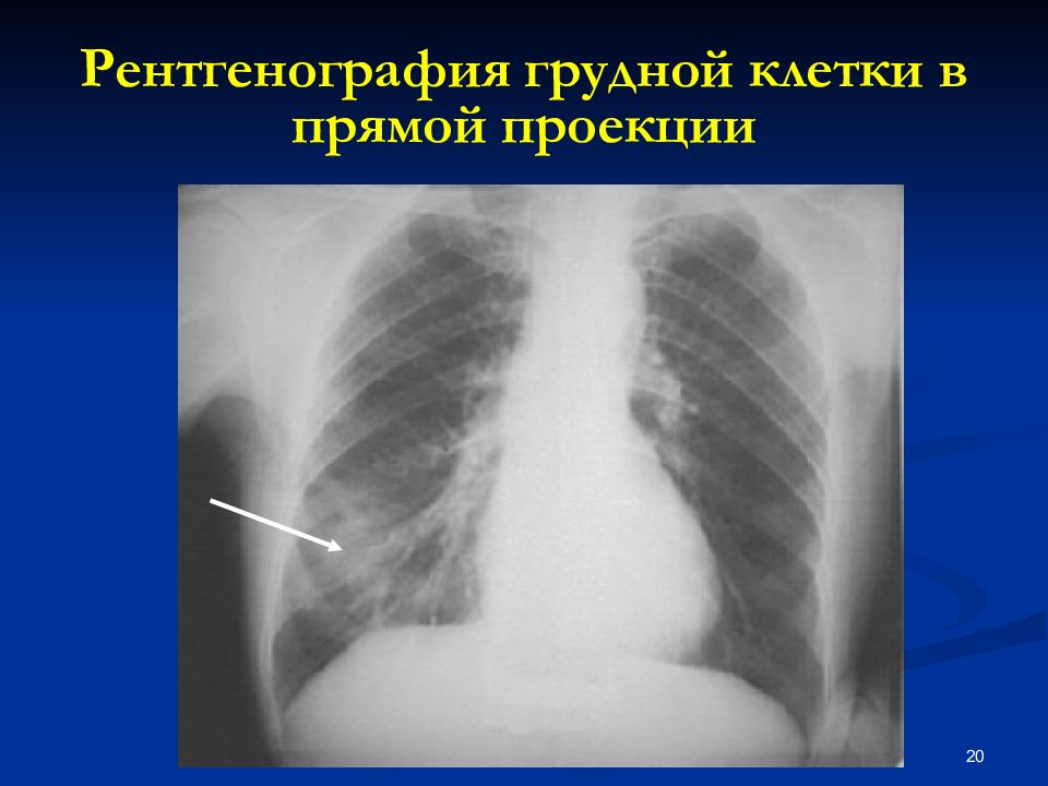 Воспалительный инфильтрат. Рентгенография легких в 2-х проекциях. Рентген грудной клетки пневмония. Рентгенография грудной клетки в прямой проекции. Рентген грудной клетки воспаление легких.