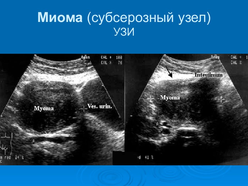 Миома матки причины. Некроз миоматозного узла на УЗИ. Узиекроз миоматозного узла.