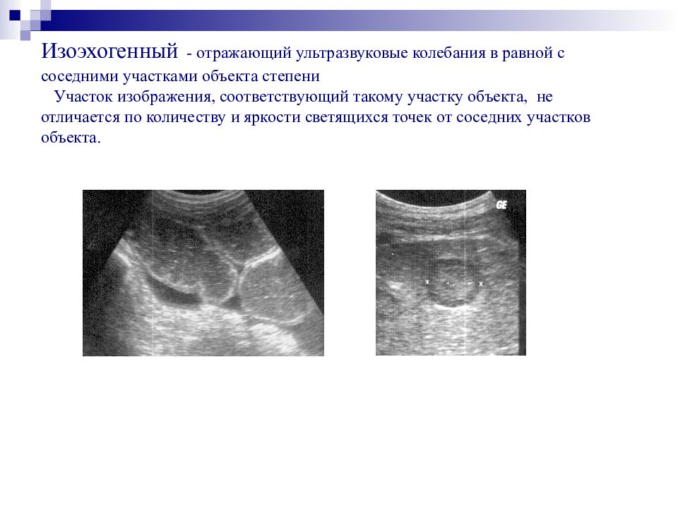 Структура узи. Изоэхогенное образование на УЗИ. Что такое изоэхогенное неоднородная образование. Изоэхогенная структура это.