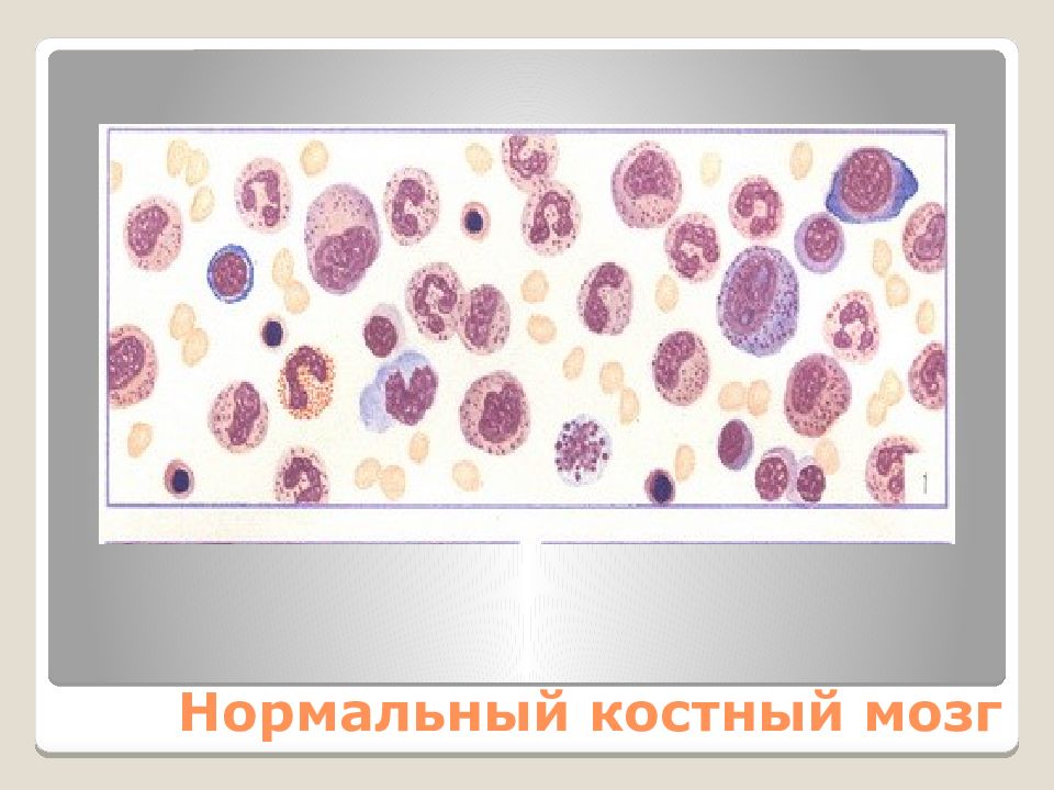 Гемобластозы патологическая анатомия презентация