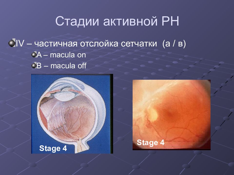 Ретинопатия недоношенных презентация