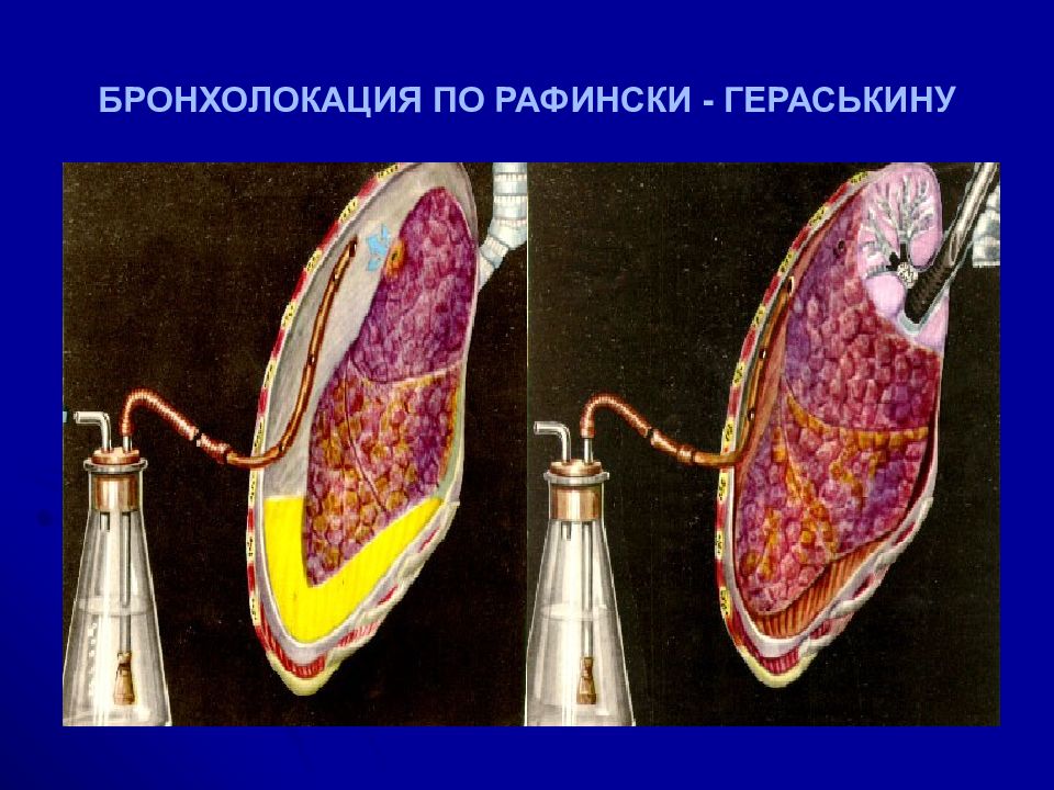 Острая гнойная деструктивная пневмония у детей презентация