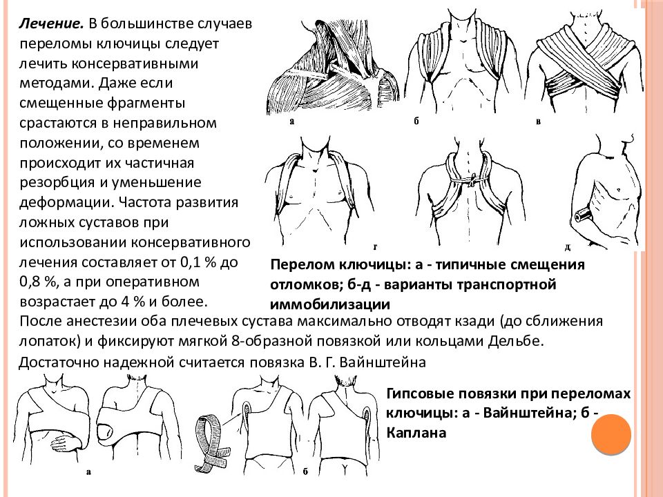 Переломы ключицы презентация