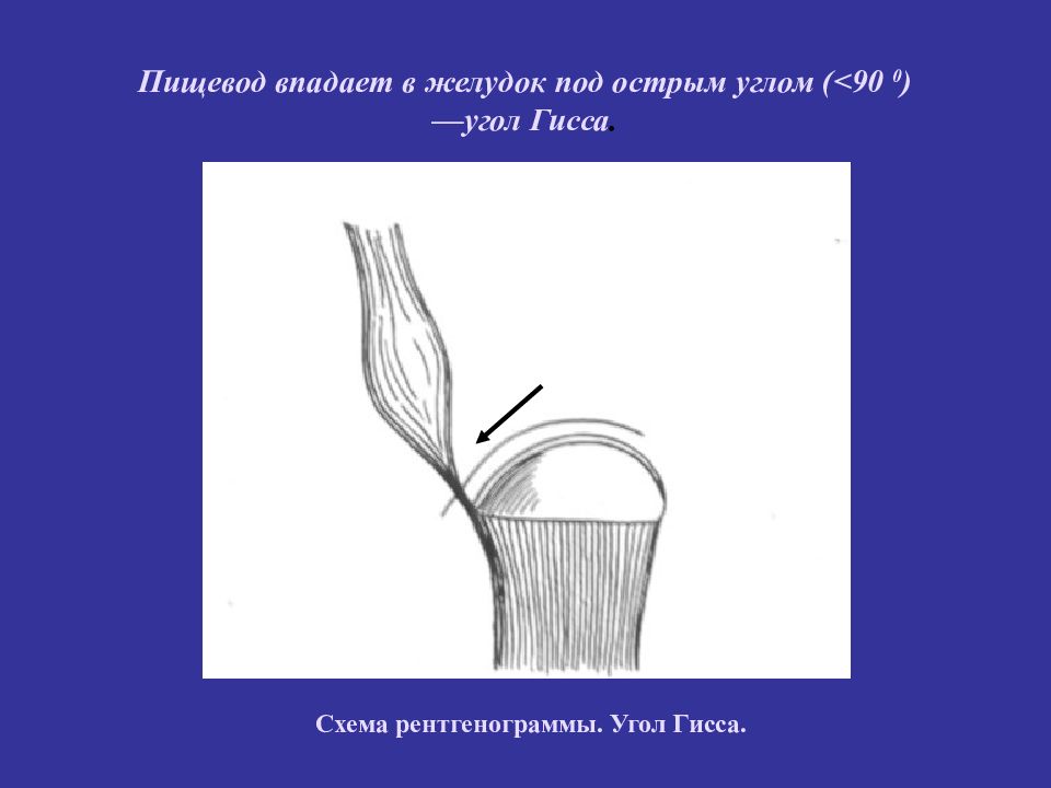 Под острым. Пищевод впадает в желудок. Пищевод схема. Угол впадения пищевода в желудок. Презентация лучевая диагностика пищевода желудка.