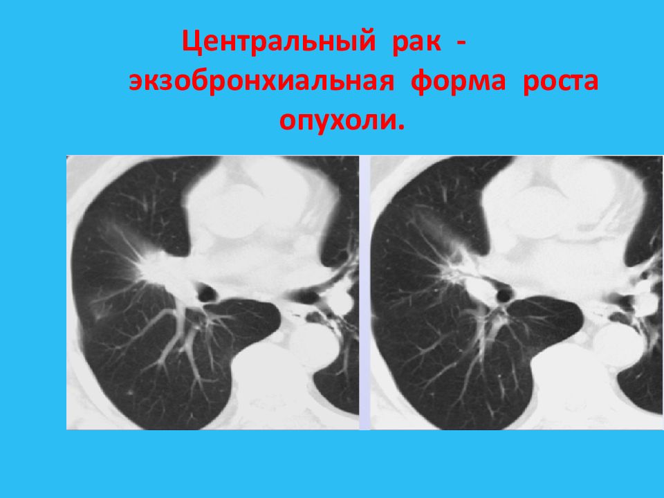 Центральное легкое. Центральные опухоли легких. Экзобронхиальная опухоль. Экзобронхиальный рост опухоли. Рентген экзобронхиальной опухолью.