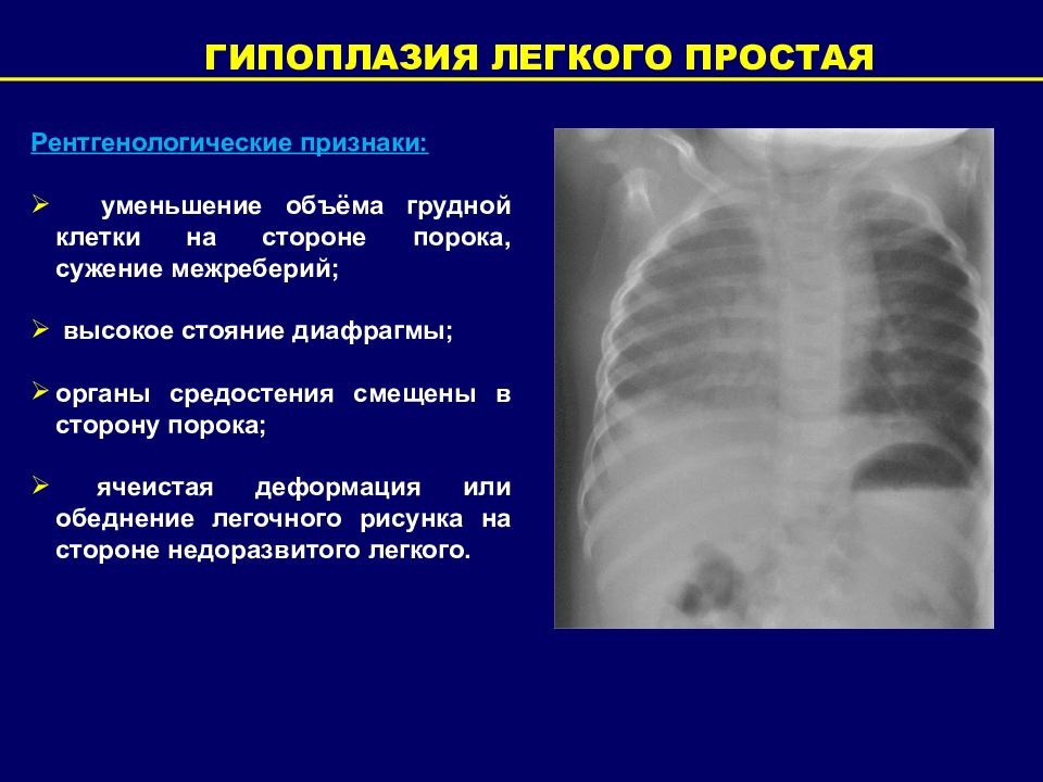 Ячеистая деформация легочного рисунка