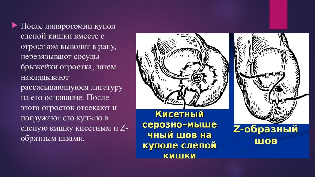 Купол слепой кишки где находится рисунок