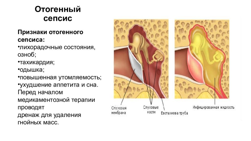 Отогенный сепсис картинки