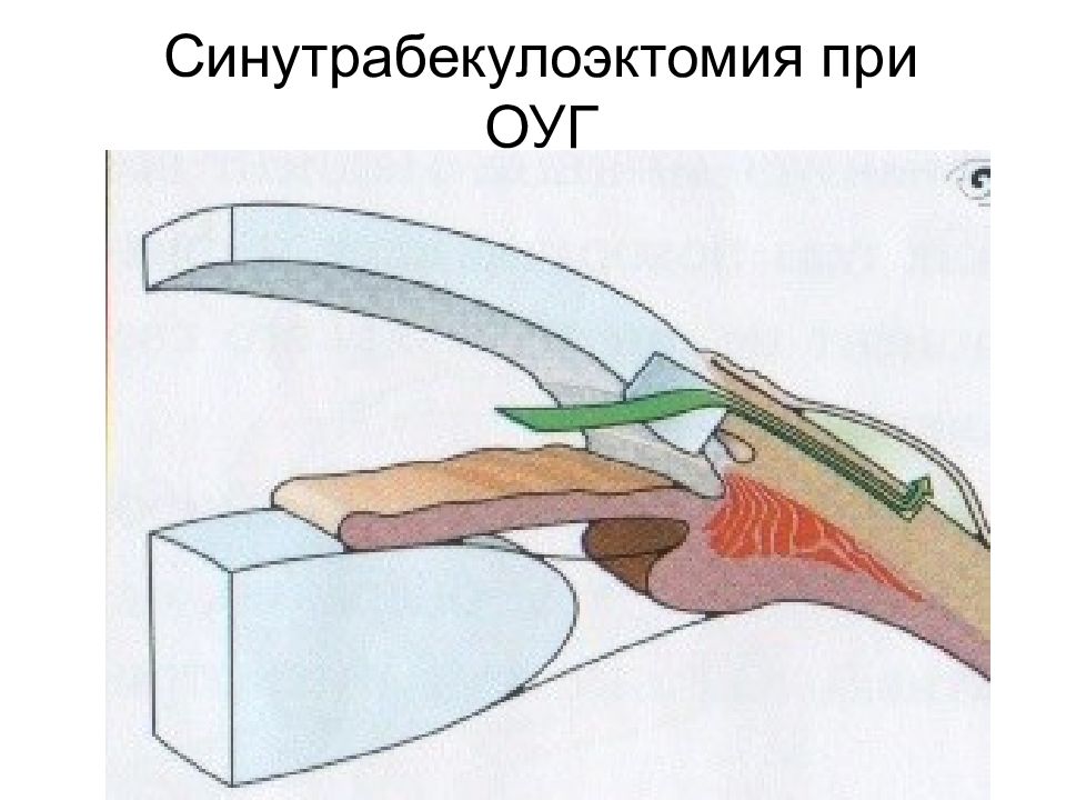 Патология внутриглазного давления презентация