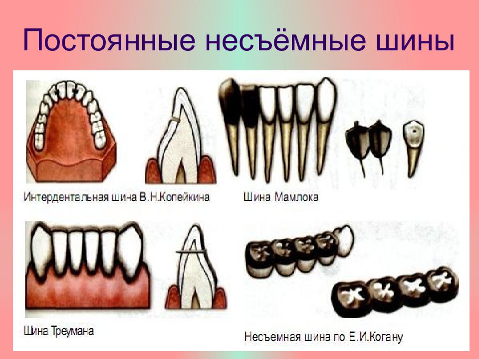 Постоянное шинирование при заболеваниях пародонта презентация