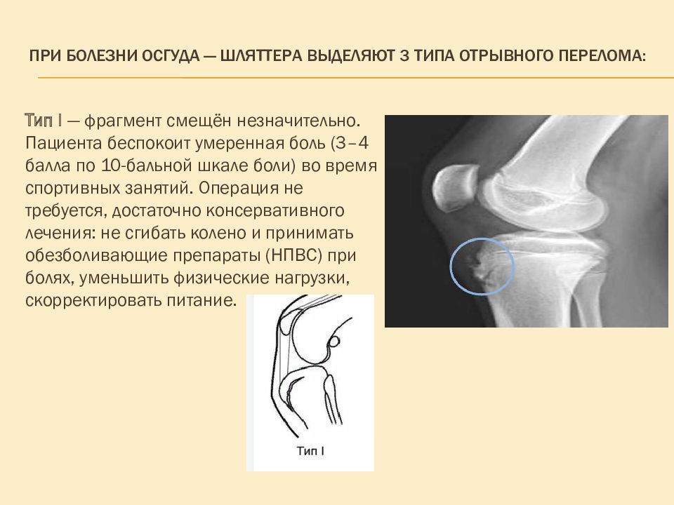 Болезнь осгуда шлаттера