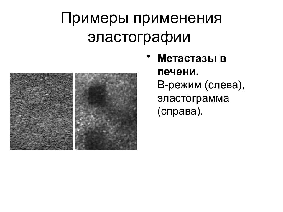 Что такое эластография печени. Эластография печени лекция. Нормальная эластичность печени. График эластографии печени. Класс по эластографии печени.
