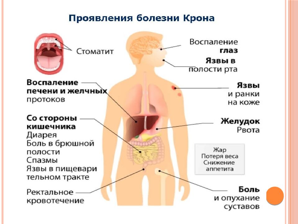 Болезнь крона клиническая картина