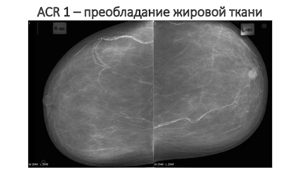 Институт маммографии. ACR 3 маммография что это. ACR классификация маммография. Маммография презентация. Строение молочной железы на маммографии.