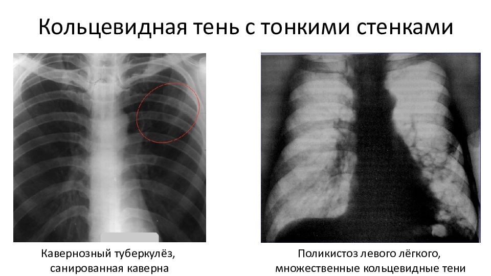 Тени средней интенсивности в легком