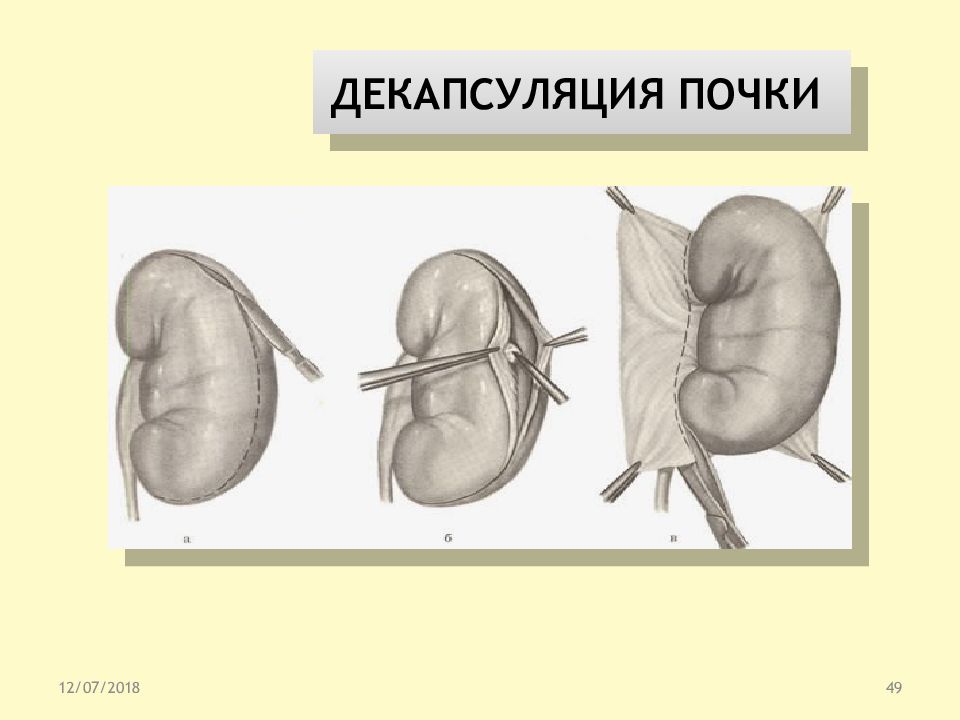 Нефрэктомия. Декапсуляция почки и нефростомия. Декапсуляция почки этапы. Декапсуляция почки операция.