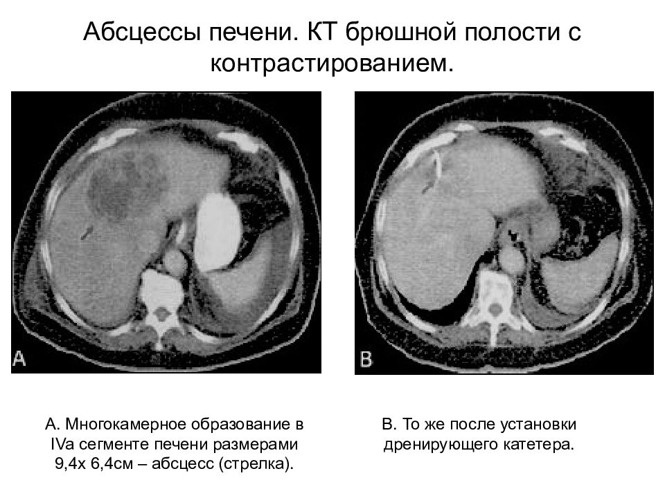 Признаки абсцесса печени на т1 взвешенных изображениях