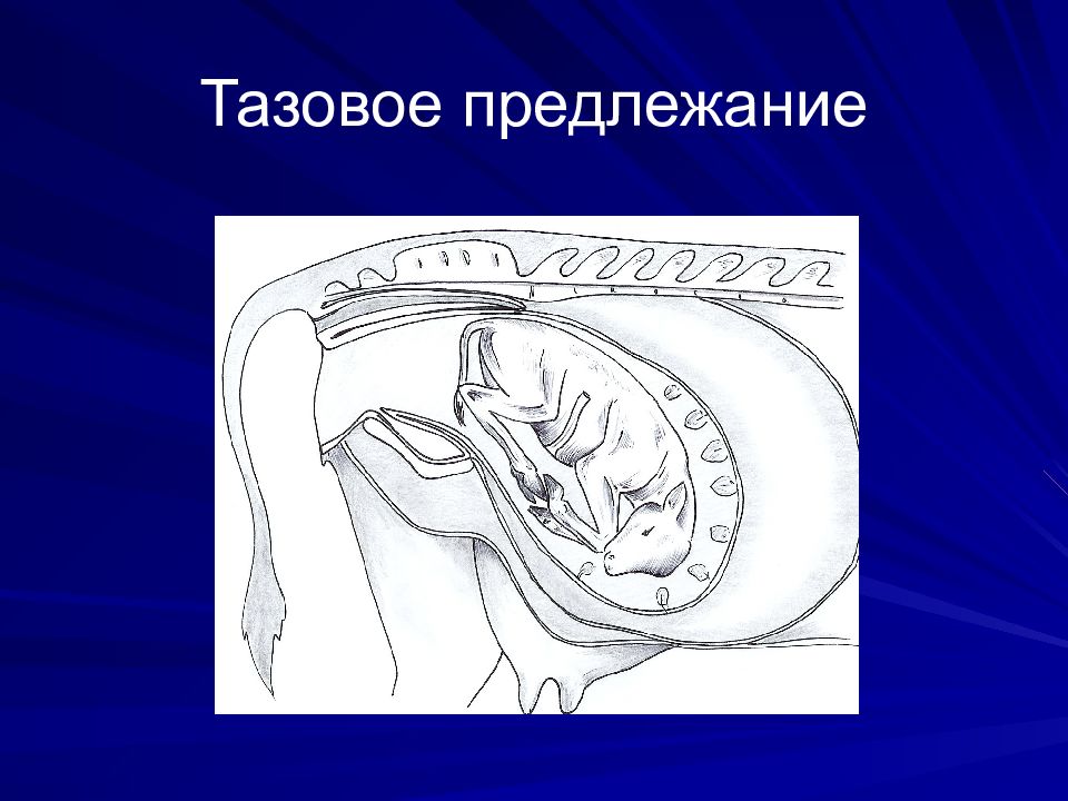 Беременности тазовая. Роды в тазовом предлежании. 31 Неделя беременности тазовое предлежание. Разогнутое членорасположение плода.