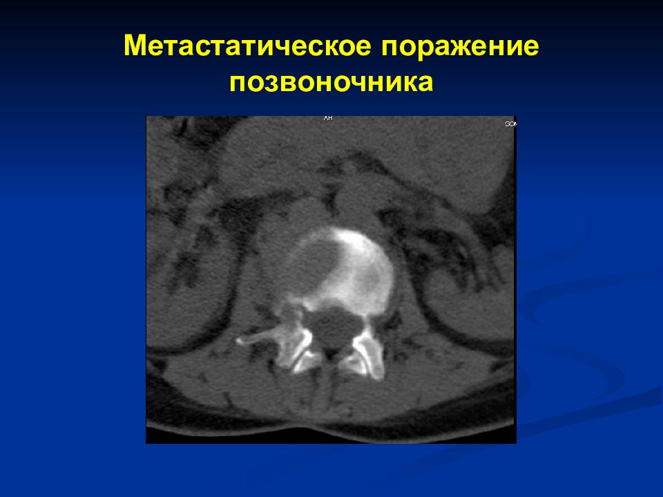 Метастатическое поражение костей. Метастатическое поражение позвоночника. Метастатическое поражение позвоночника диагноз. Метастатическое поражение позвоночника на кт.