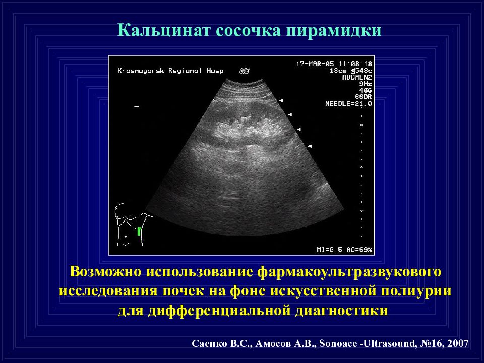 Узи картина мочекаменной болезни