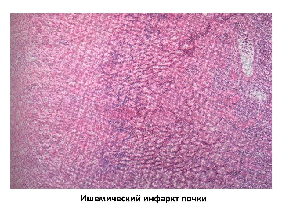Ишемический инфаркт почки