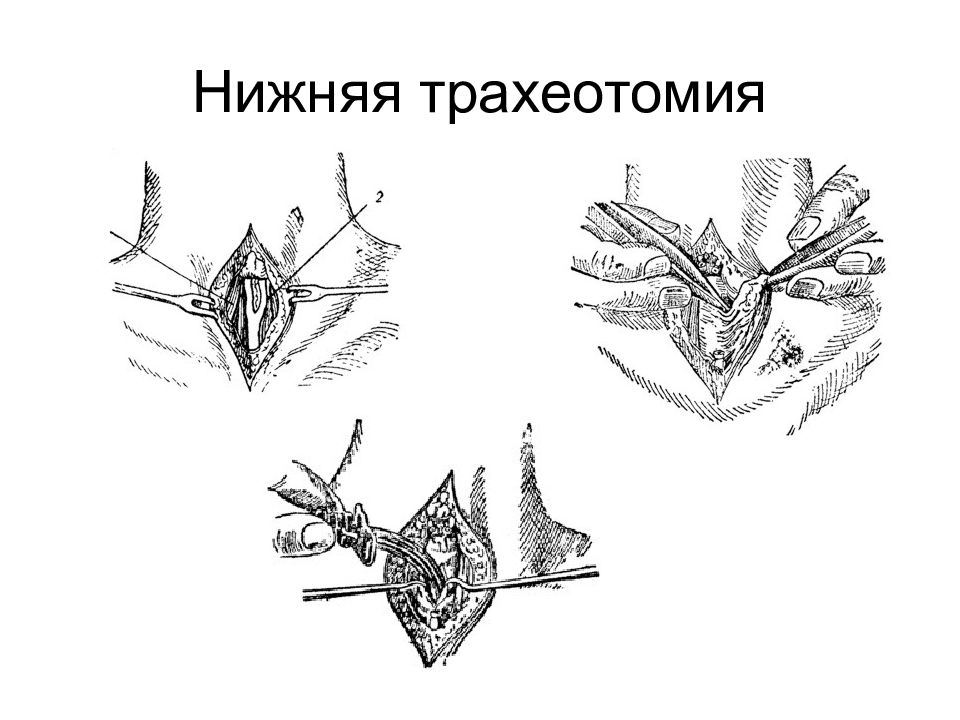 Трахеотомия. Нижняя трахеостомия техника. Верхняя и нижняя трахеостомия техника. Трахеостомия техника нижней трахеостомии.