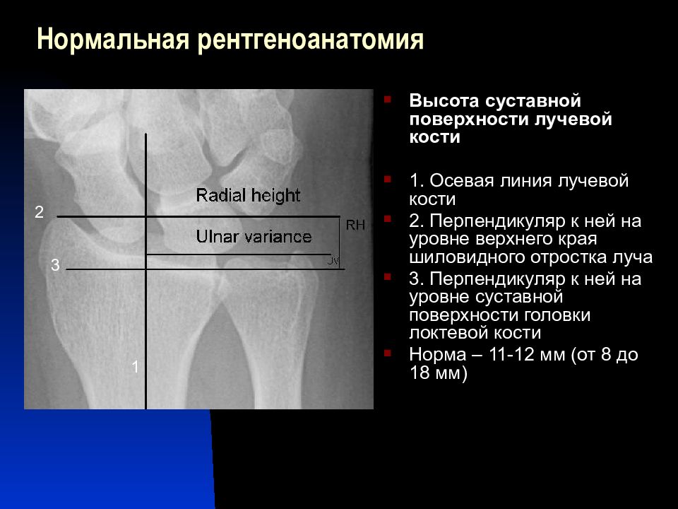 Рассмотрите рентгенограмму с изображением кисти человека как называют повреждение которое