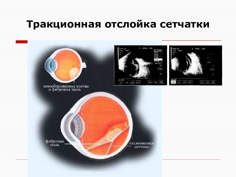 Тракционная отслойка сетчатки фото