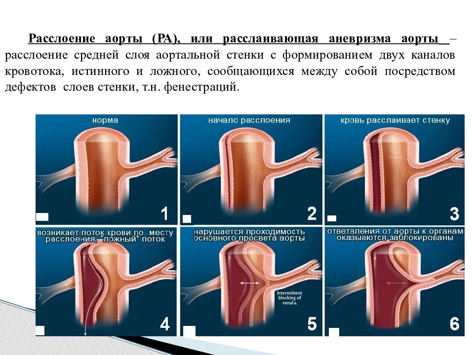 Расслаивающаяся аневризма аорты презентация