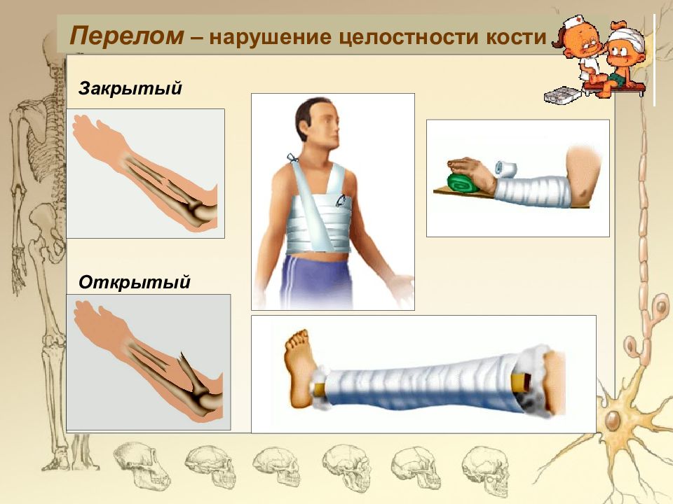 Открытый закрыть перелом. Открытый и закрытый перелом. Переломы костей закрытый открытый. Перелом конечностей открытый и закрытый. Закрытый перелом кости.