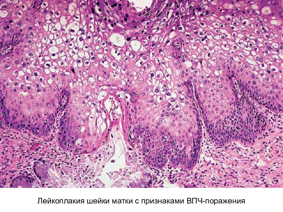 Койлоцитоз. Лейкоплакия гистология. Дисплазия шейки матки гистология. Лейкоплакия шейки матки гистология. Лейкоплакия патанатомия.