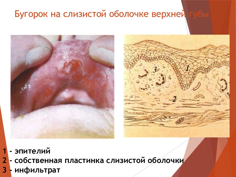 Бугорок на слизистой оболочке верхней губы