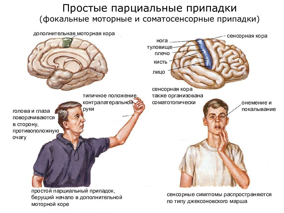 Лечение эпилепсии картинки