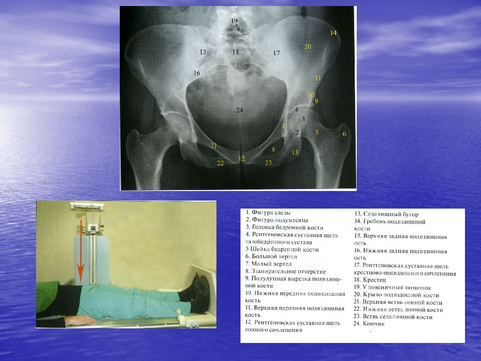 Рентгены анатомия. Рентген анатомия лонной кости. Тазобедренный сустав рентген анатомия. Нормальная рентгеноанатомия тазобедренного сустава. Нормальная рентген анатомия тазобедренного сустава.