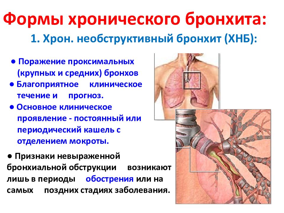 Хронический бронхит презентация