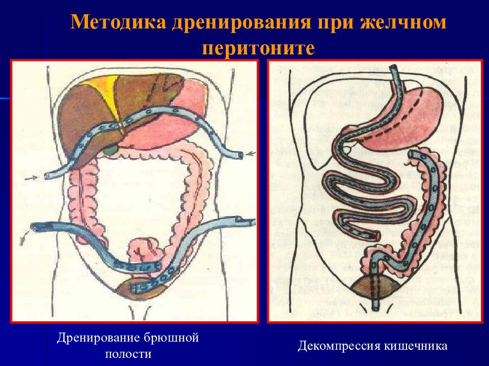 Санация кишечника что это такое