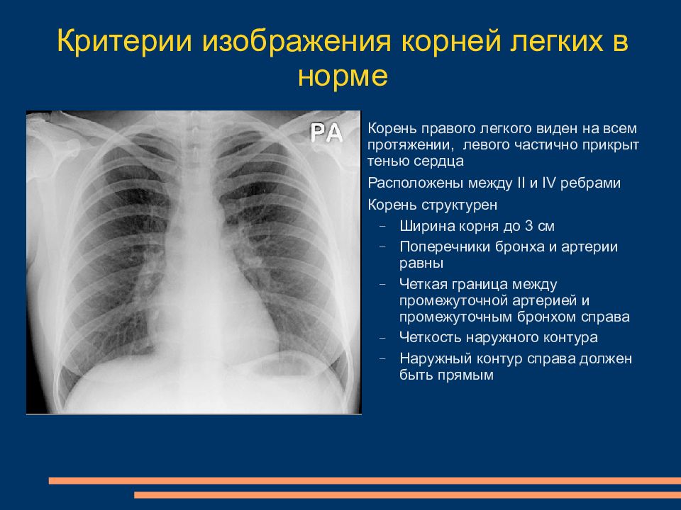 Деформация легочного рисунка. Легочной рисунок на рентгенограмме. Корни легких. Где находятся корни легких у человека фото. Полициклические контуры корней легких.