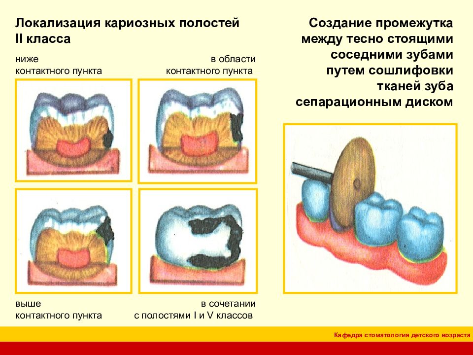 Классификация кариозных полостей по блэку презентация