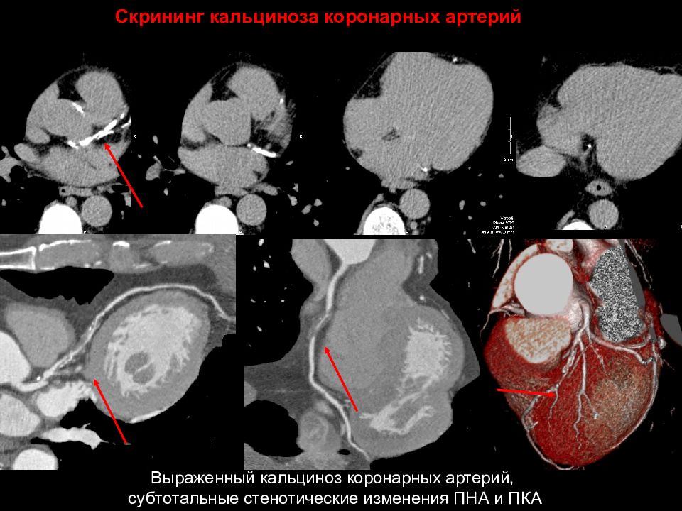 Кт скрининг коронарного кальция