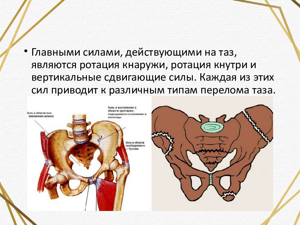 Травмы костей таза