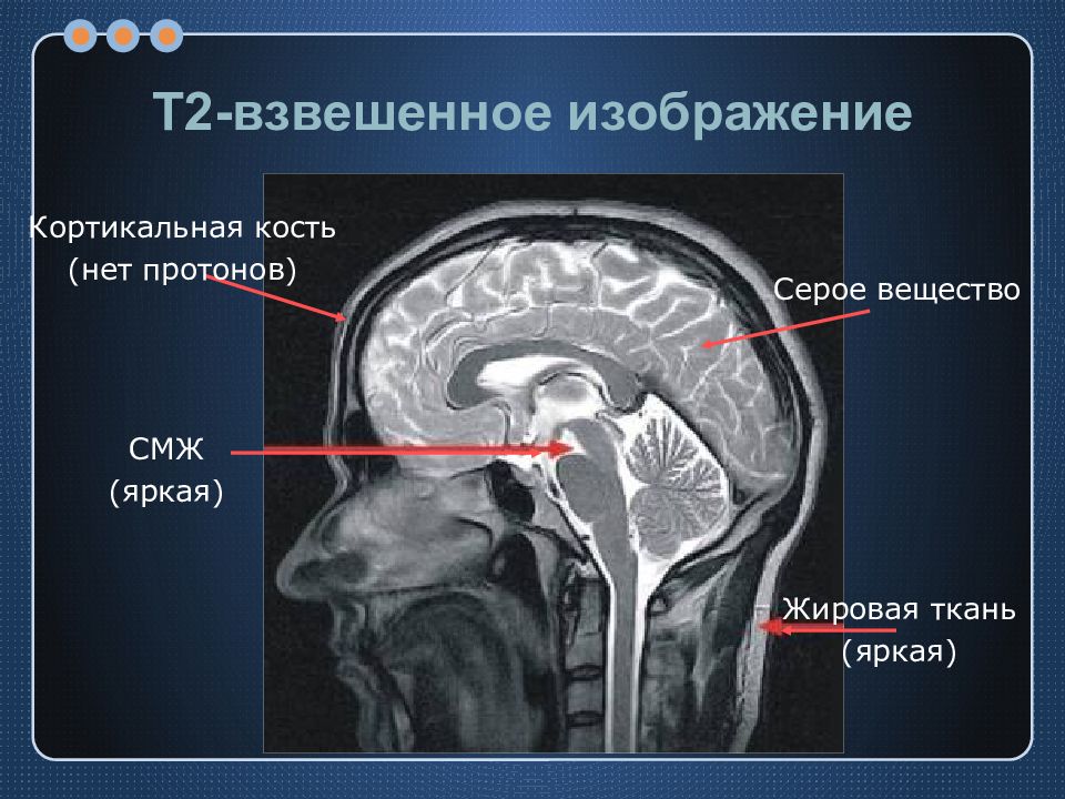 На т2 взвешенных изображениях при нативной магнитно резонансной томографии хорошо визуализируются