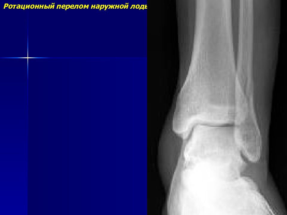 Переломы лодыжек презентация