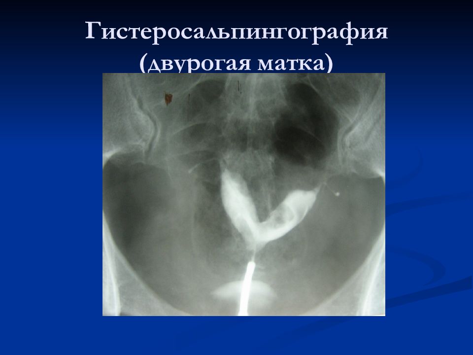 Гсг. Гистеросальпингография двурогая матка. Двурогая матка рентген. Гистеросальпингография при двурогой матке.