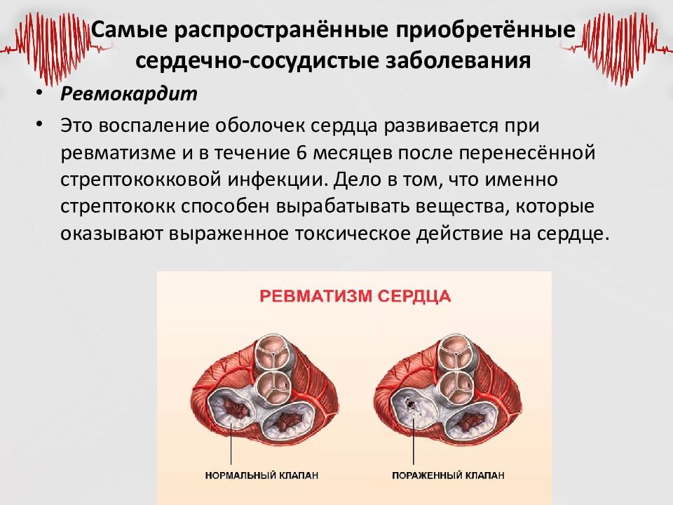 Ревмокардит. Заболевания сердечно-сосудистой системы список. Заболевания сердца список. Самые распространенные сердечно-сосудистые заболевания. Распространенные заболевания ССС.