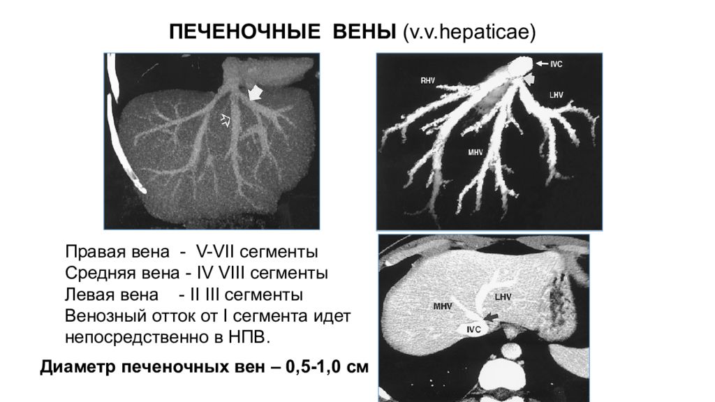 Печеночных вен. Правая и левая печеночные вены. Правая печеночная Вена.