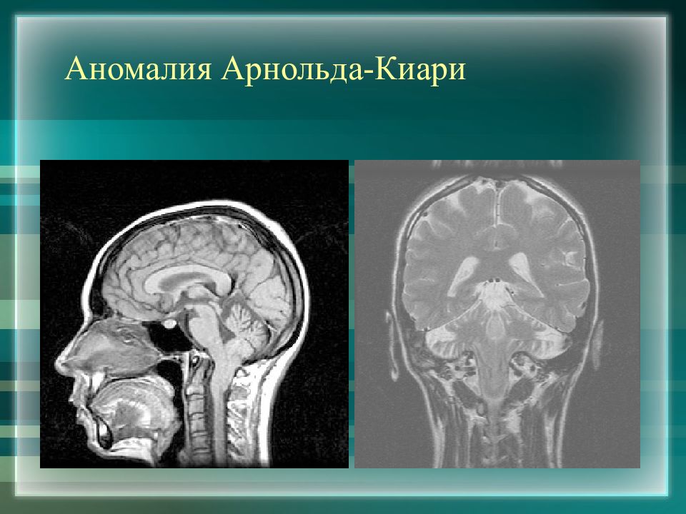 Мальформация арнольда киари. Аномалия Арнольда Киари мрт. Мрт головного мозга при Арнольда Киари. Болезнь аномалия Арнольда Киари.