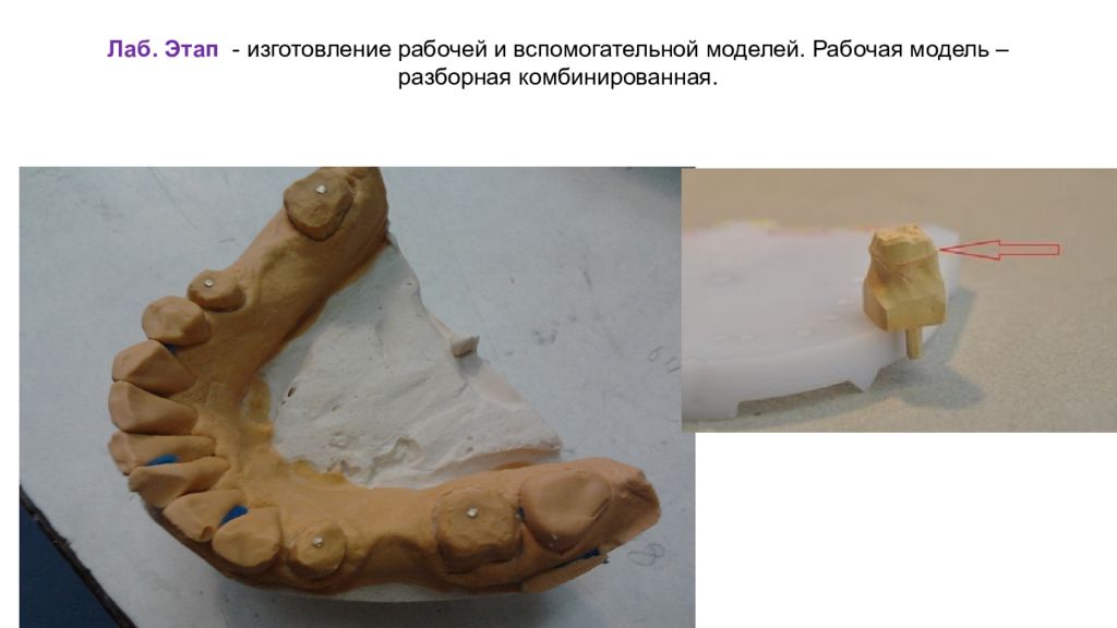 Рабочая модель. Бесштифтовой метод разборная модель. Этапы изготовления разборной модели. Разборная рабочая модель. Этапы изготовления комбинированной разборной модели..