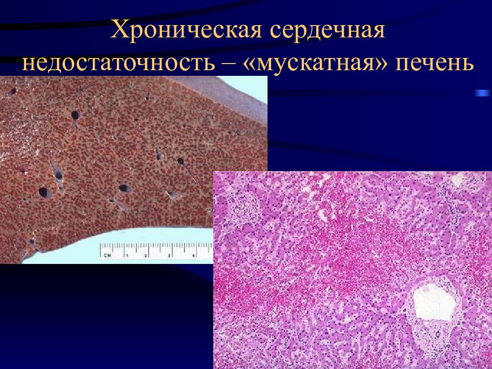 Ибс патологическая анатомия презентация